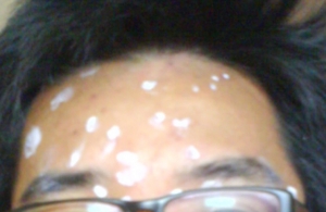 pox